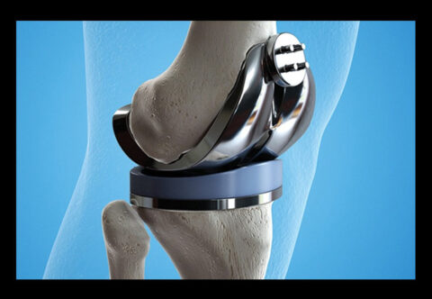 Global Orthopedic Implants Market Outlook