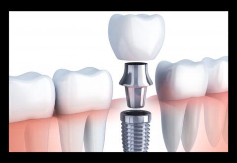 Dental Implants Market Outlook